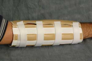 EMAdamsCo.Com - Vinyl Elbow Splint